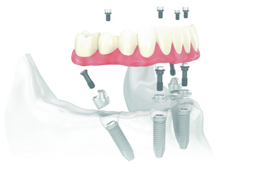 Diagram of All-on-4 Treatment Concept at Singing River Dentistry in Russellville, AL 