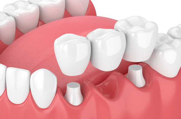 Rendering of jaw with dental bridge at Singing River Dentistry in Russellville, AL 35653