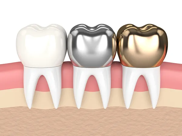 3D rendered cross-section view of three teeth with dental crowns made of different materials at Singing River Dentistry in Russellville, AL