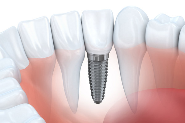 Diagram of dental implant in lower jaw at Singing River Dentistry in Russellville, AL