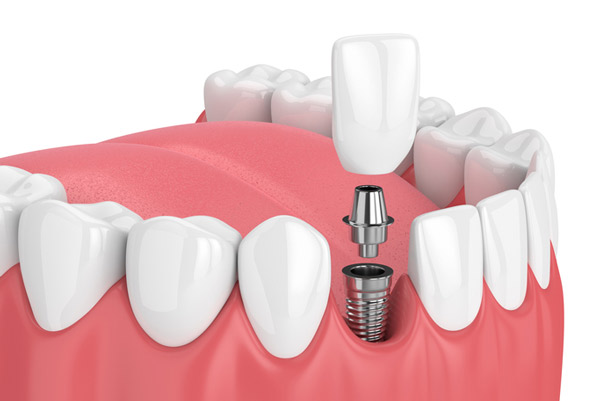 Image of a dental implant 3D model at Singing River Dentistry.