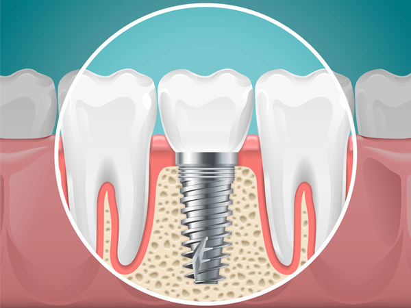 Diagram of a tooth replaced with a dental implant by Singing River Dentistry in Russellville AL 35653 