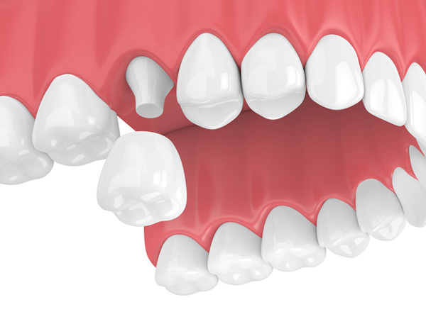 Rendering of jaw with porcelain crown.