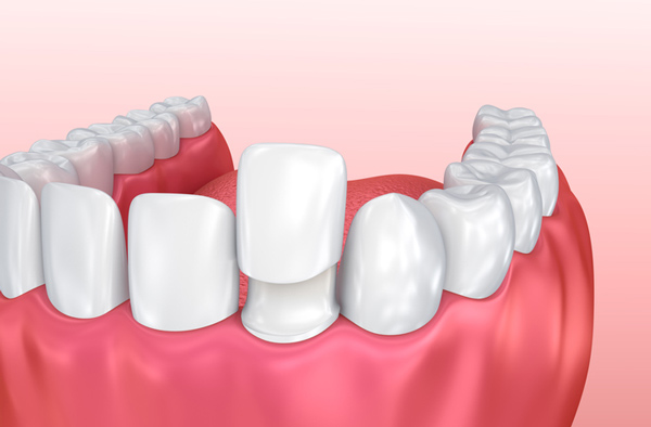 Rendering of jaw with porcelain veneer at Singing River Dentistry in Russellville, AL 