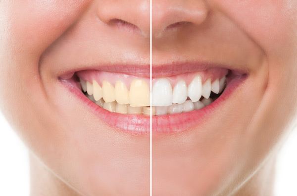 Before and after photo of teeth whitening treatment at Singing River Dentistry in Russellville, AL 