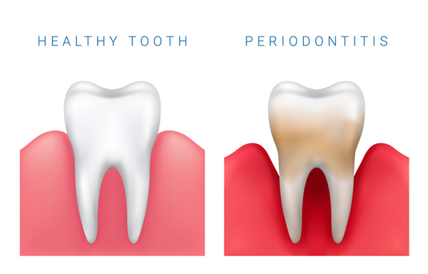 A graphic showing why periodontal disease mainenance is important to follow going to Singing River Dentistry in Russellville, AL