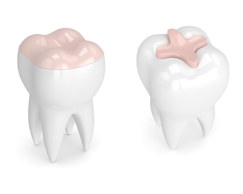 3D Rendering of inlays and onlays offered at Singing River Dentistry in Russellville, AL 35653 