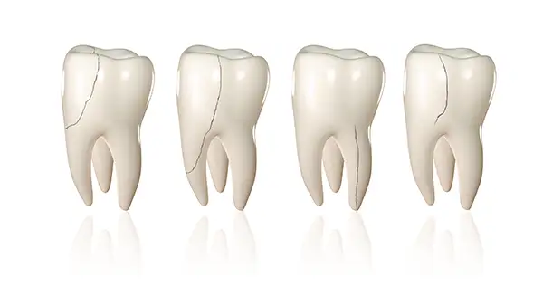 A set of four teeth showing four different variations in tooth fractures and severity.