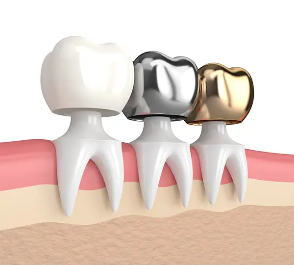Ceramic, metal, and gold dental crowns placed on a gum model, illustrating how crowns fit over teeth.